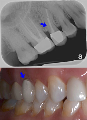 Fractured Tooth Before Treatment