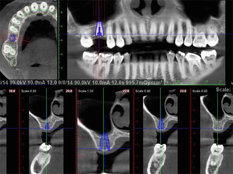 CT Scan Implant Plan