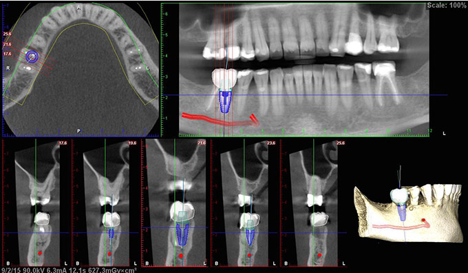 CT Scan Implant Planning