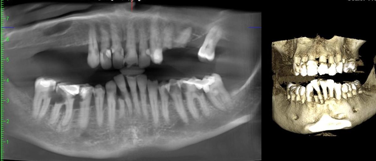 CT implant planning