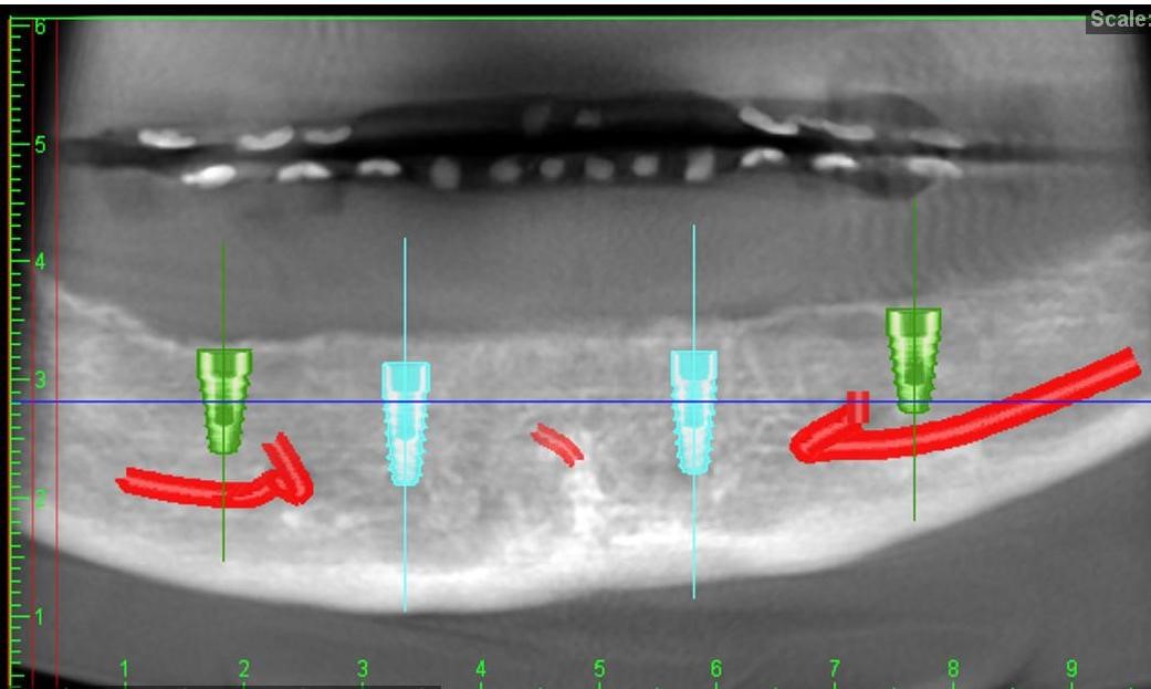 CT used to plan 4 Implants on the lower jaw