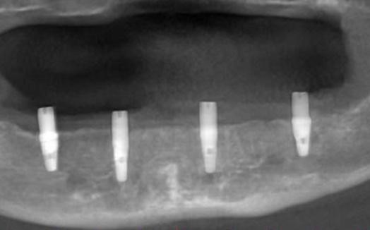 CT used to verify precise placement of implants within the bone