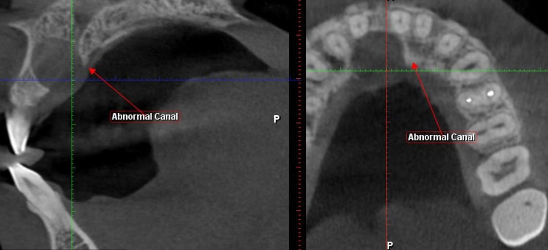 Example #2 of what a Cyst looks like