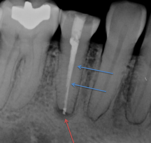 Dead Tooth with Infection