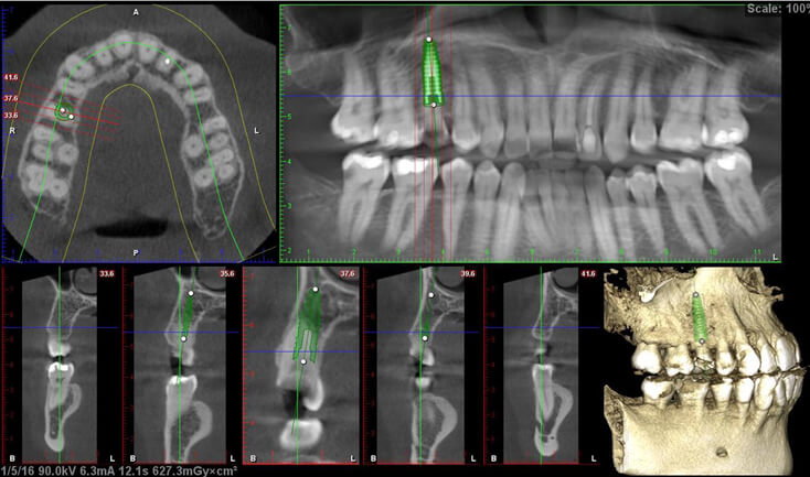 Decayed tooth CT planning