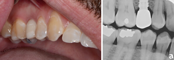 Final restoration picture showing implant