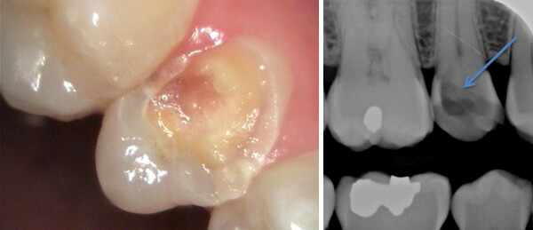 Decayed tooth before dental implant