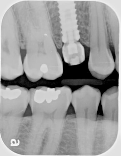 Implant day of surgery