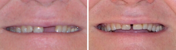 Custom Tooth Shading Before and After
