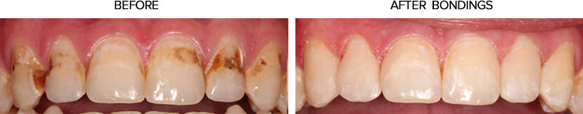 Dental bonding before and after