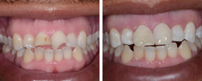 Dental Bonding Before and After