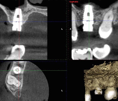 Dental Implant Results After 3 Months