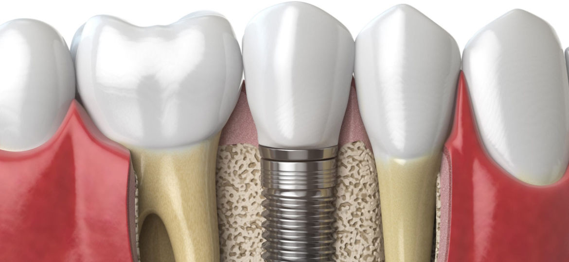 How Much Does a Dental Implant Cost?