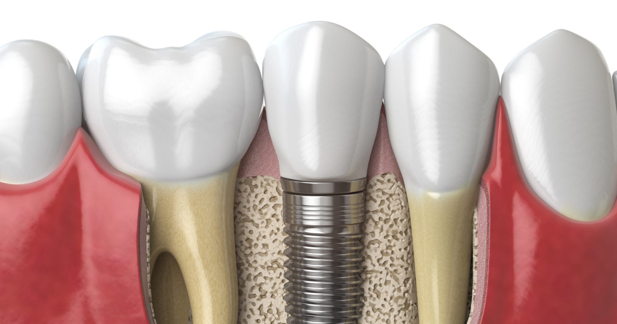 How Much Does a Dental Implant Cost?
