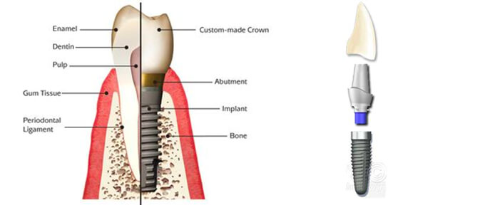 Diagramme d'implant dentaire