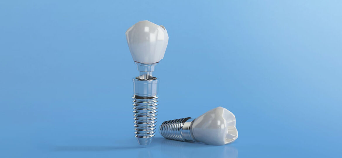 Dental Implant Facts