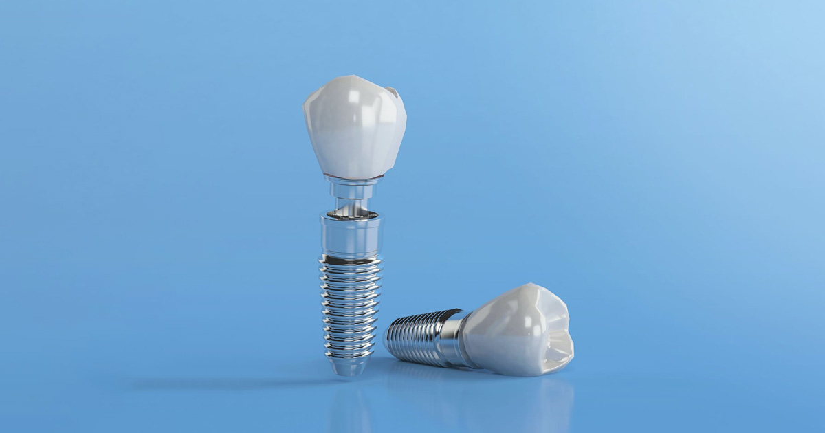 Dental Implant Facts