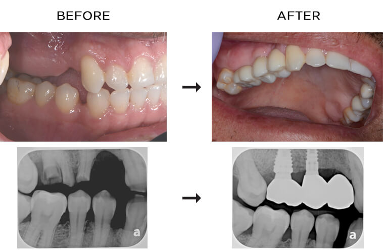 Dental Implants Before and After