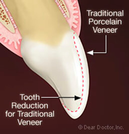 Thin Dental Veneers