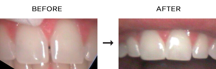 Diastema before and after