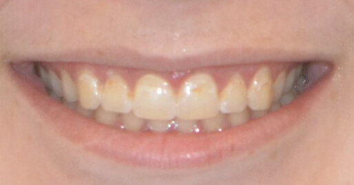 Tooth discoloration from braces