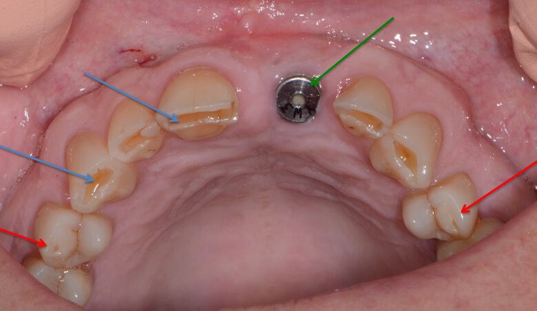 Effects of tooth grinding