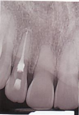 Endodontic Therapy Completed