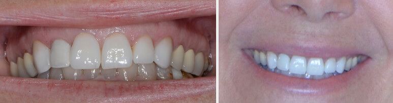 Esthetic implant final result