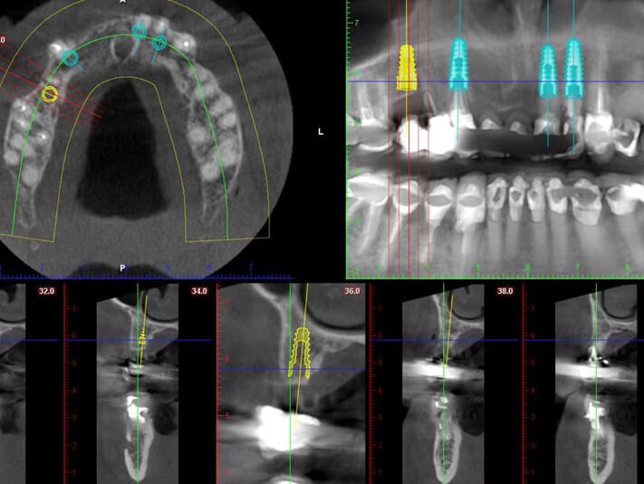 CT planning for new implant bridge