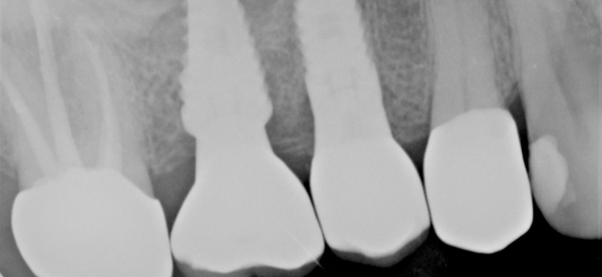 Failed Bridge and Replacement of Seven Teeth