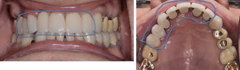 Photos of the failed dental bridge