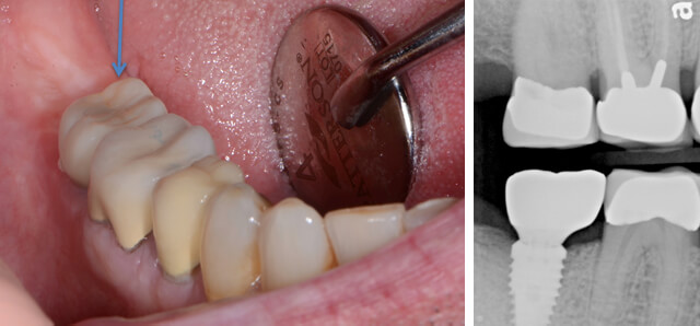 Final Product – Abutment and Crown in the mouth