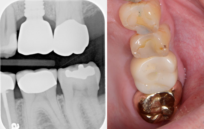Final restoration on the implant