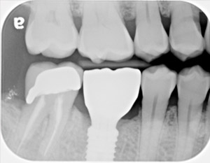 Final restoration with dental implant