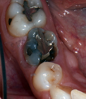 Fractured Adult Baby Tooth Before