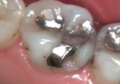 Broken Tooth with Metal Filling