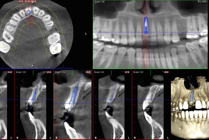 Front Tooth CT Scan Planning