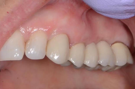 After gum graft