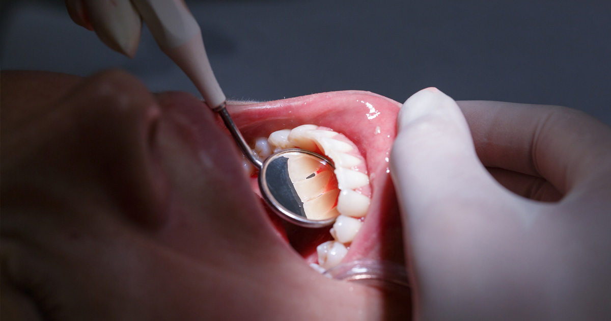 What is Gum Recession?