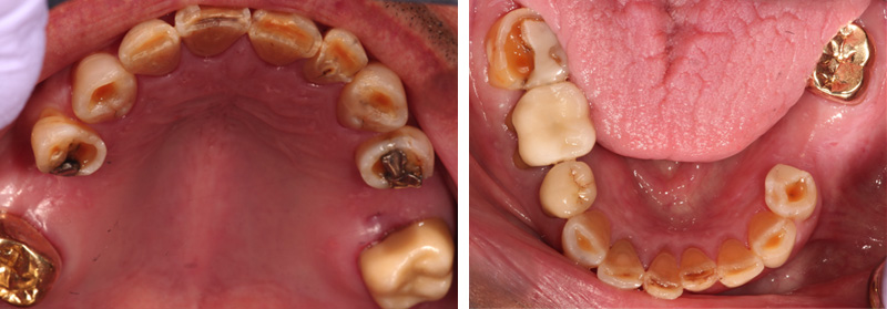 Images of tooth wear