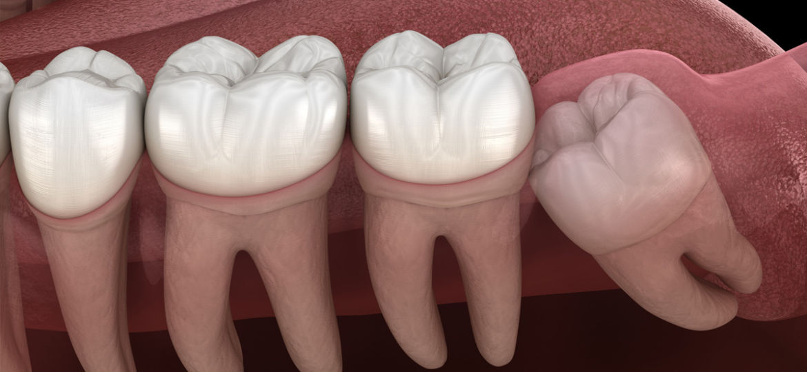 Why Do Some Wisdom Teeth Need to be Taken Out?