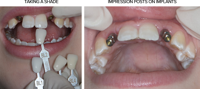 Implant Restorations