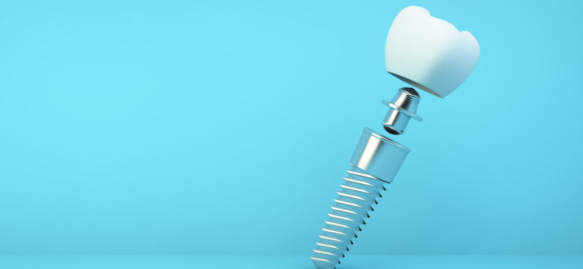 What is an Implant Abutment?