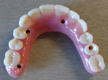 Implant bridge