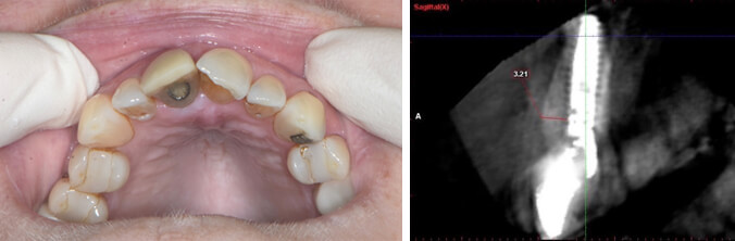 Implant in excellent surgical and prosthetic position