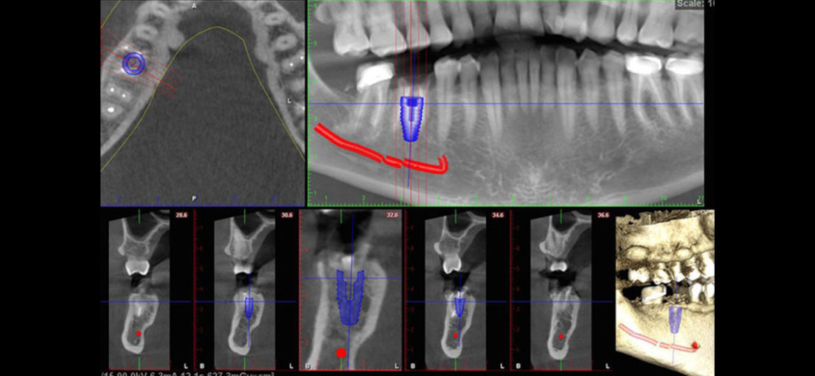 Implant Scenario: Broken Tooth