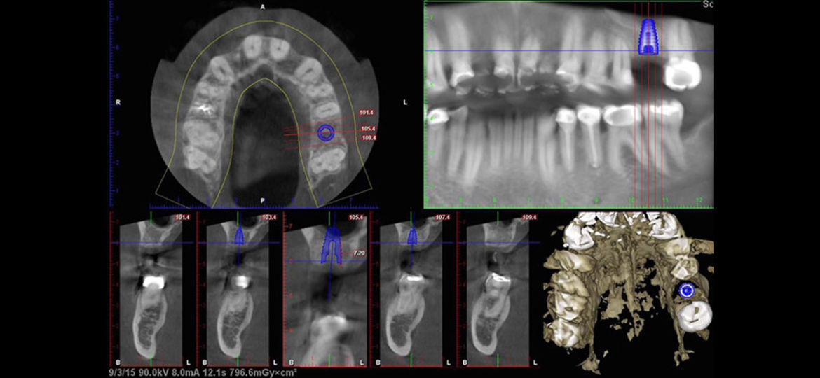 Implant Scenario: Infected Tooth