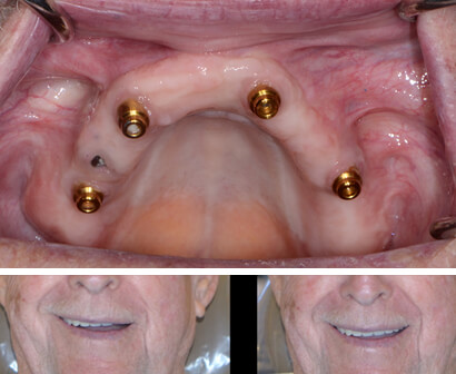 Implant supported denture attachment
