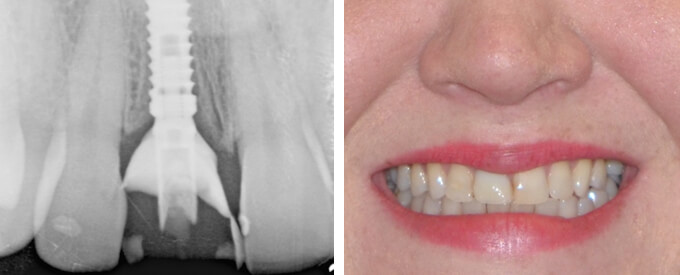 Implant and Temporary Tooth