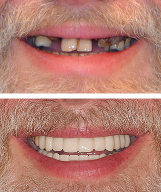 Dental Implants Before and After - Case #1 Dental Implants Before and After - Case #1